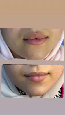 الشايب ايليت للتجميل والليزر