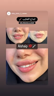 الشايب ايليت للتجميل والليزر