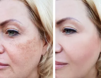 عيادات نورميسا | جلدية | تجميل | ليزر