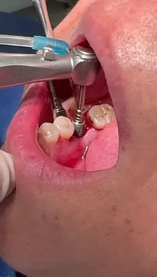 عيادة د.احمد سمار لطب وجراحة الفم وزراعة الاسنان